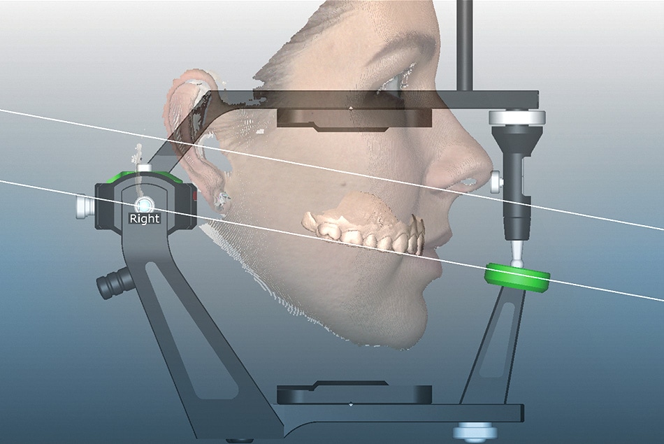 Virtual Articulator Lafond Desjardins Laval Dental Laboratory