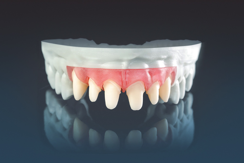 SCAN INTRAORAL / IMPRESSION DE MODÈLE Laboratoire Dentaire Laval