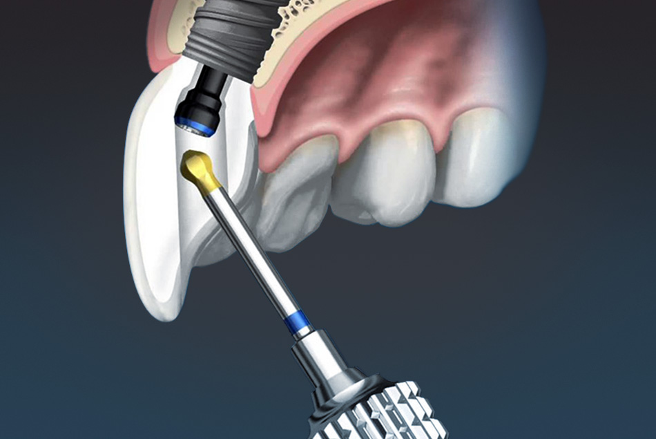 Axis alignment