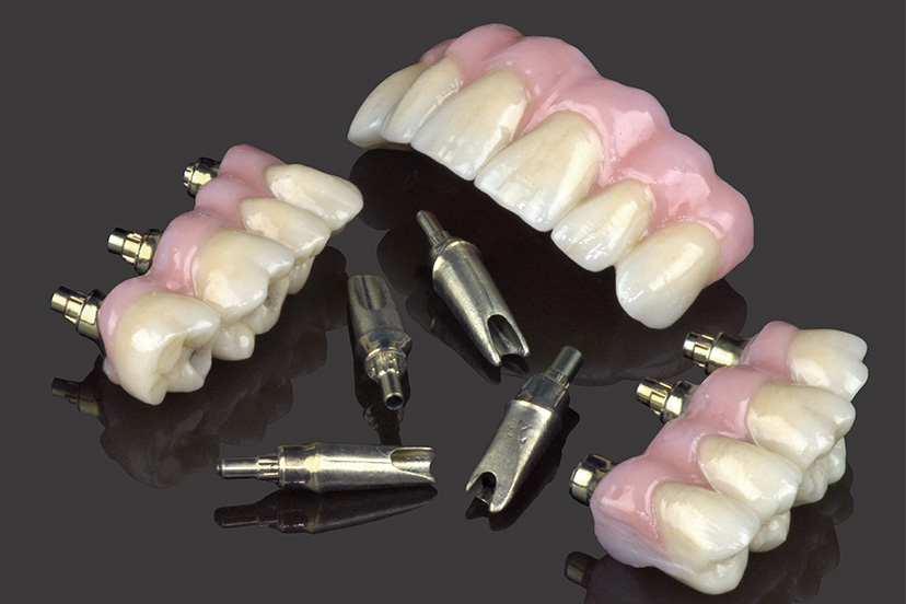 SCREW-RETAINED OR CEMENTED CROWN AND BRIDGE