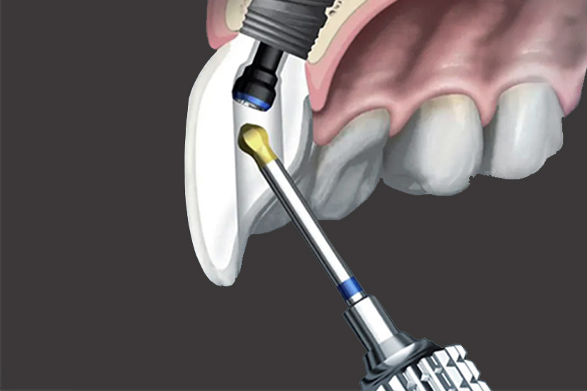 ANGULATED SCREW CHANNEL